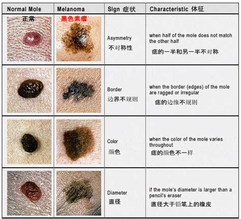 有問題的痣|痣也可能会癌变！长在 3 个地方要注意